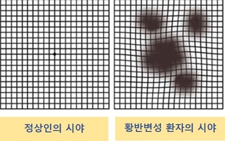 정상인과 황반변성환자의시야 ⓒ타임즈 